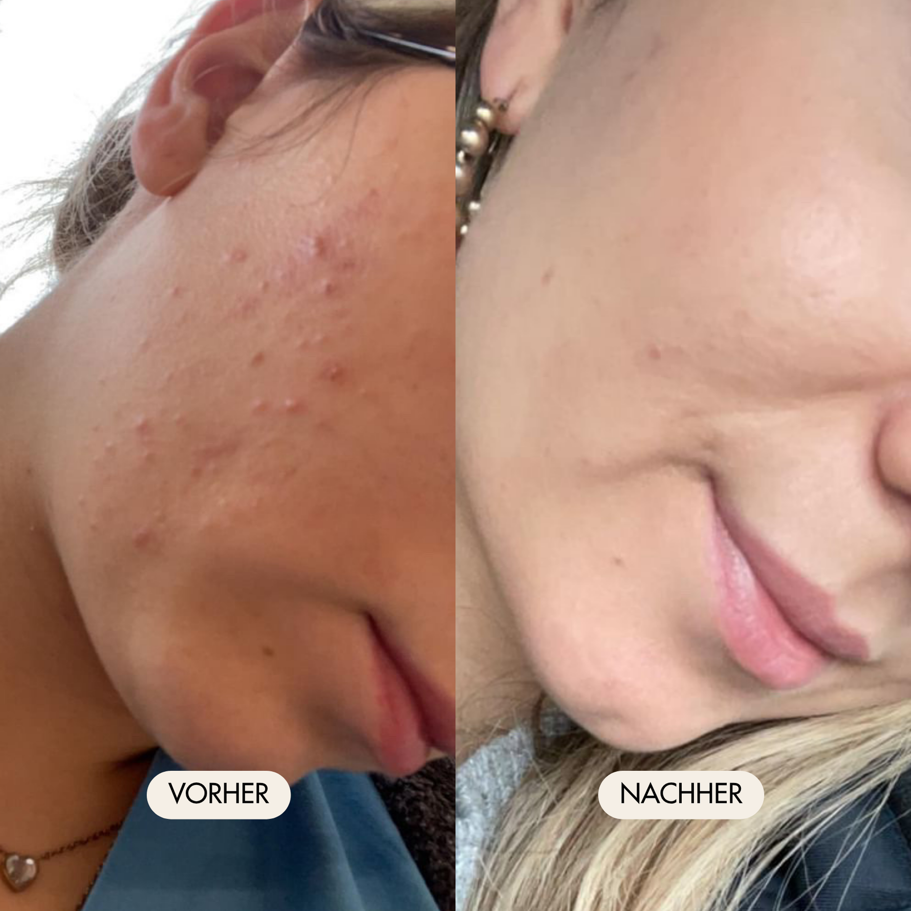 Vorher-/Nachher Vergleichsbild zeigt weniger Unreinheiten nach der Anwendung des Blossom Beauty Anti-Aging Drink