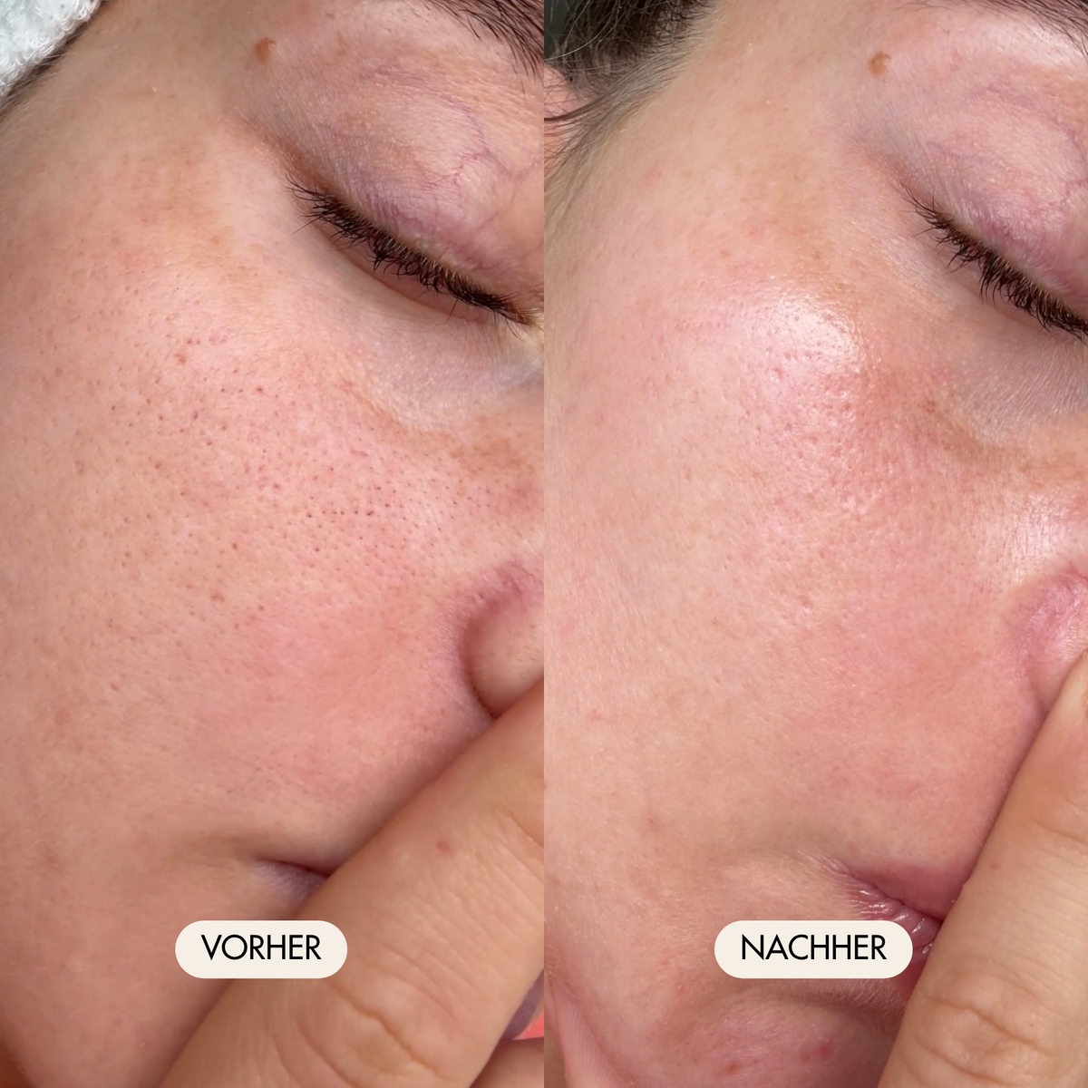Vorher-/Nachher Vergleichsbild zeigt strahlende, frische und gereinigte Haut und weniger Poren nach der Anwendung mit dem Payalove Cleanser