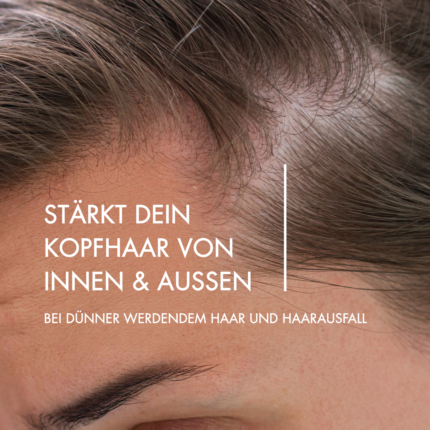 Nahaufnahme von einer Kopfhaut mit dünnem Haar und Geheimratsecken. Daneben steht in weißer Schrift: "Stärkt dein Kopfhaar von innen und außen. Bei dünner werdendem Haar und Haarausfall"