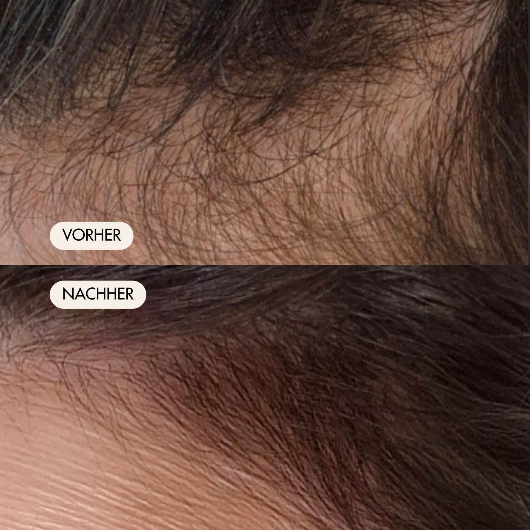 Vorher-/Nachher Vergleichsbild zeigt vollere Haare und dichteren Haaransatz nach der Einnahme der Haarkapseln