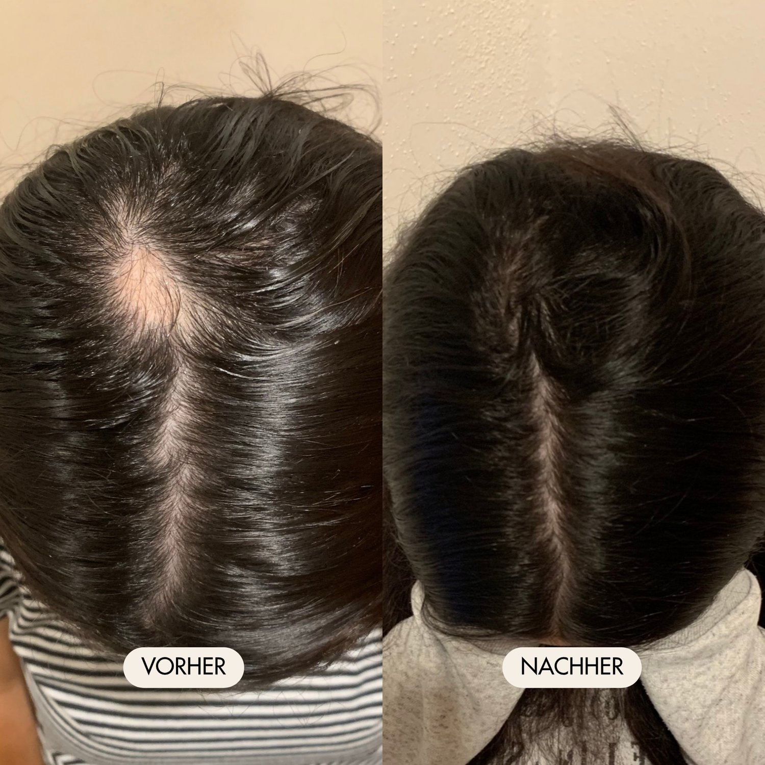 Vorher-/Nachher Vergleichsbild zeigt deutlich dichtere Kopfhaut und neu nachgewachsene Haare nach der Anwendung des Haarserums und den Haarkapseln