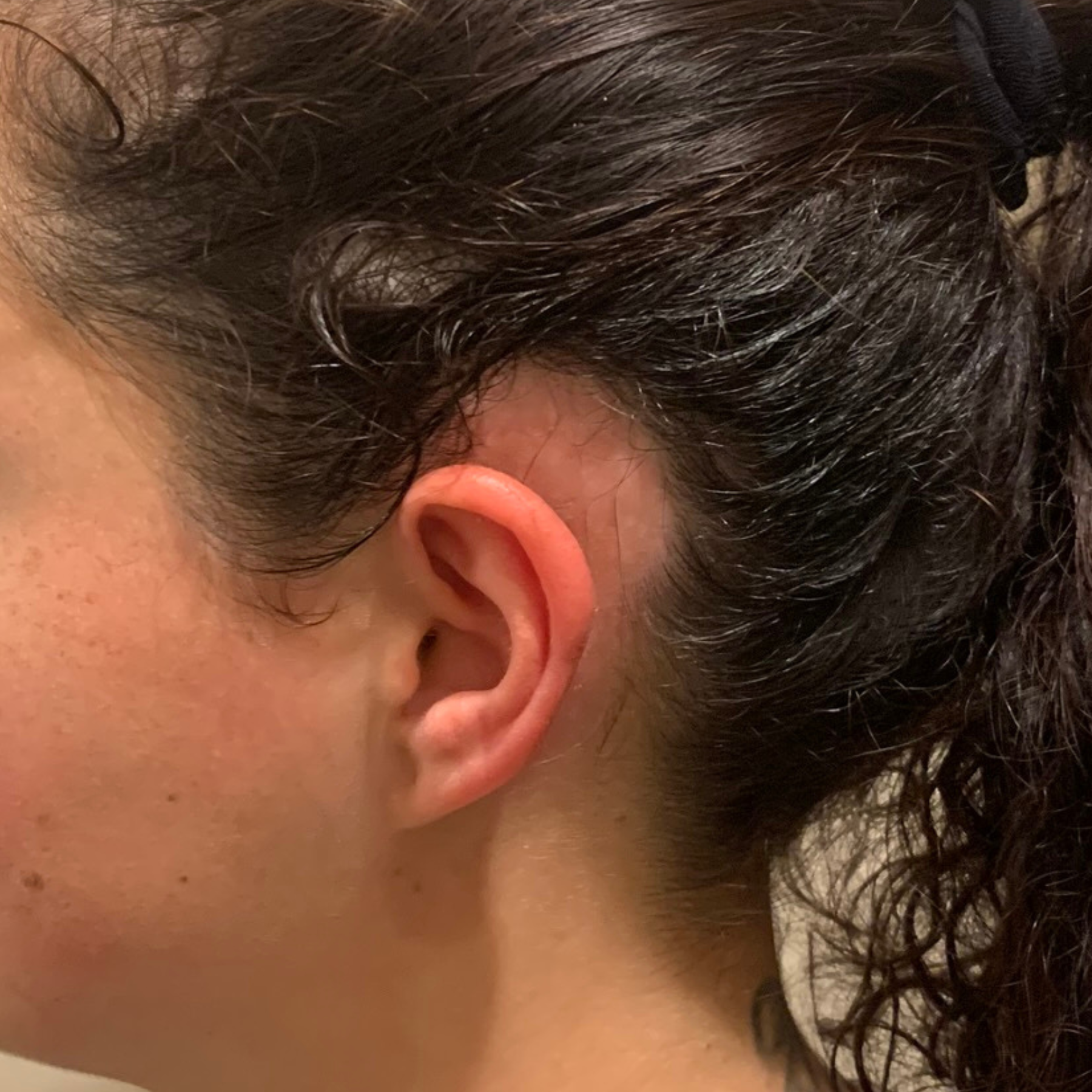Vorher-Vergleichsbild zeigt starke kahle Stelle hinter den Ohren am Haaransatz vor der Anwendung des Haarwuchsmittel
