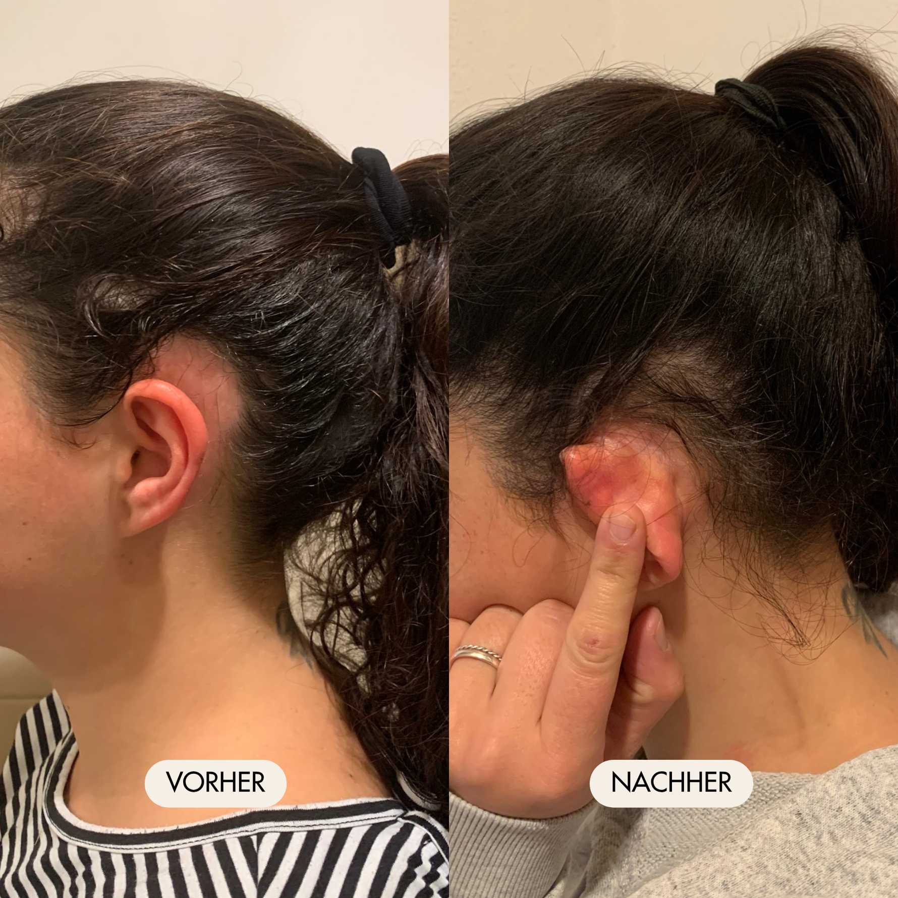 Vorher-/Nachher Vergleichsbild zeigt nachgewachsene Haare einer Frau auf der Seite des Kopfes