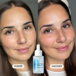 Vorher-/Nachher Vergleichsbild zeigt glatte, feste und strahlende Haut nach der Anwendung des Hyalove Hyaluronserums