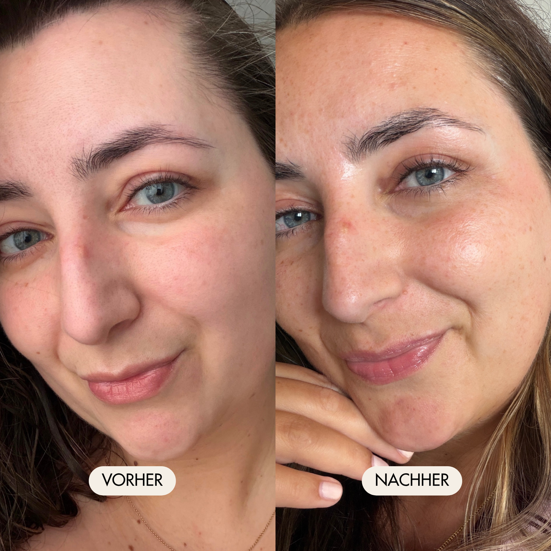 Vorher-/Nachher Vergleichsbild zeigt  glatte, feste und strahlende Haut nach der Anwendung der Hyalove Glas Skin Routine