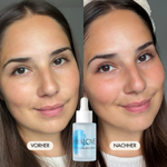 Vorher-/Nachher Vergleichsbild zeigt glatte, feste und strahlende Haut nach der Anwendung des Hyalove Hyaluronserums