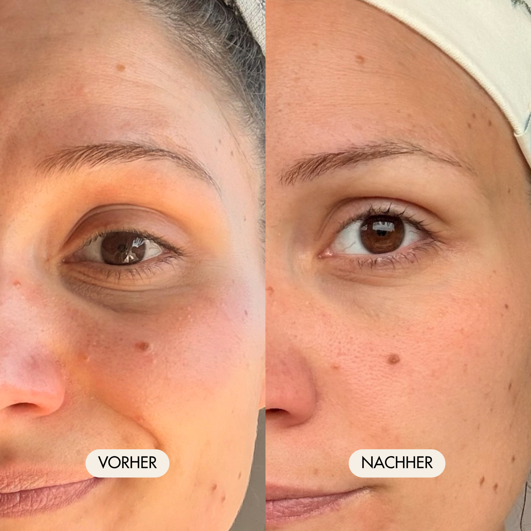 Vorher-/Nachher Vergleichsbild zeigt sichtbar reduzierte Augenringe und deutlich erholte, frische Augenpartie nach der Anwendung der Hyalove Augencreme