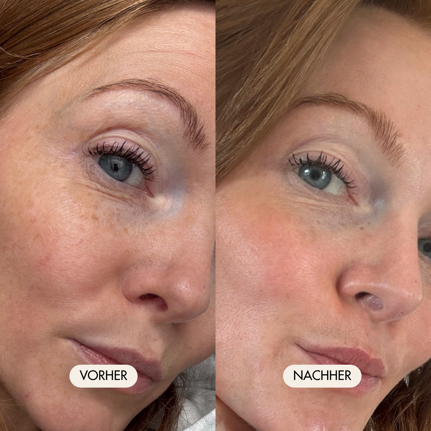 Vorher-Nachher Bild einer jungen Frau, die Luxury Lift Augencreme angewendet hat. Die Falten, schwellungen und dunkle Stellen ums Auge sind deutlich reduziert