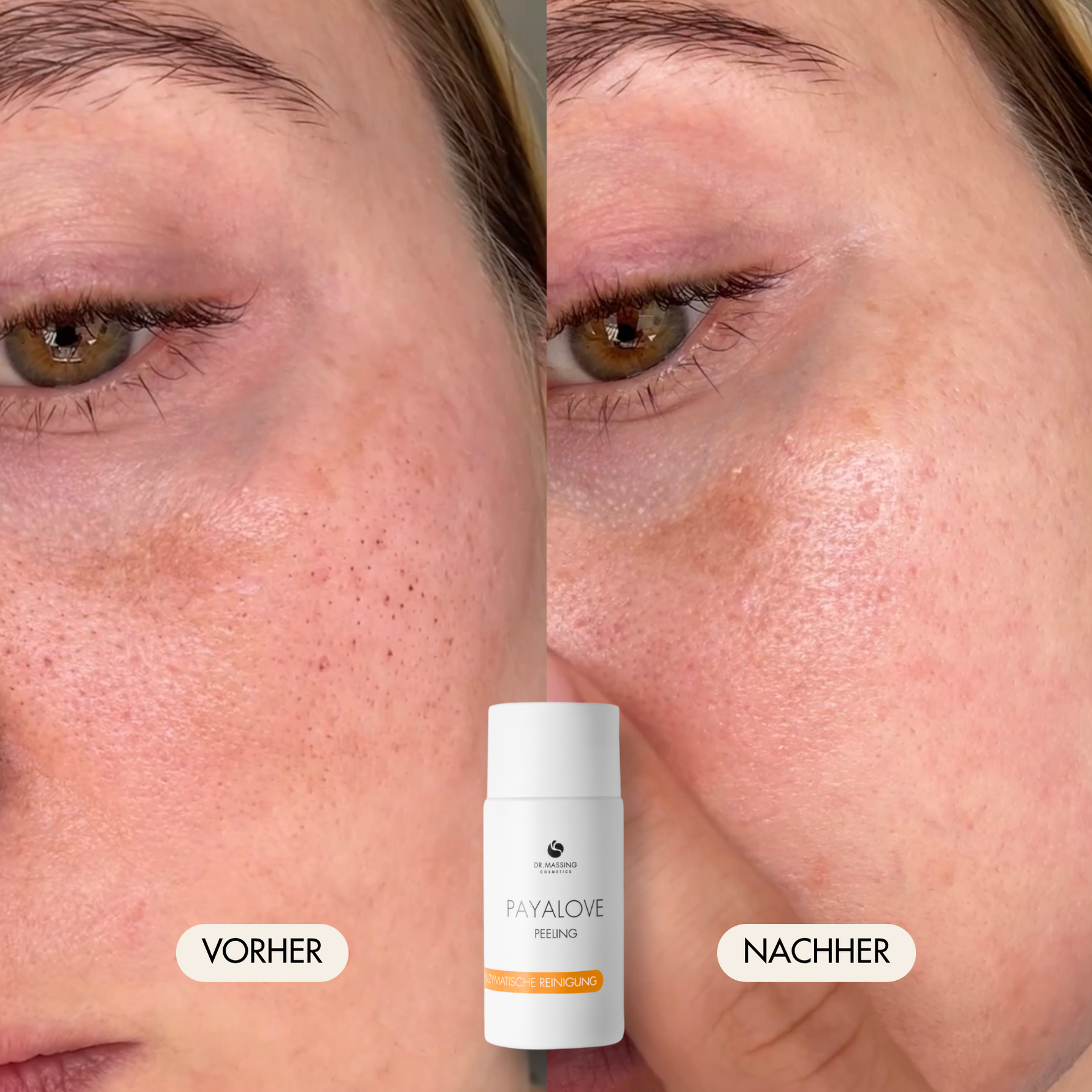 Vorher-/Nachher Vergleichsbild zeigt strahlende, verfeinerte Haut mit weniger Poren nach der Anwendung mit dem Payalove Peelings
