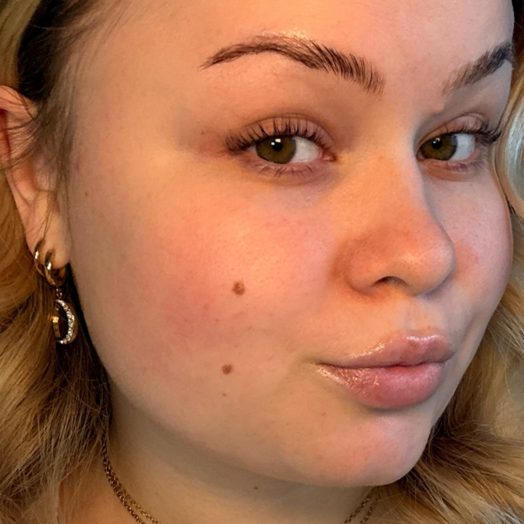 Junge Frau mit fahler und trockener Haut vor der Anwendung des Hyaluronserums