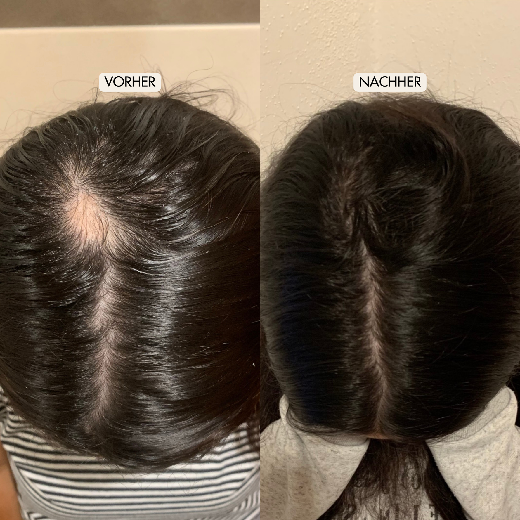 Vorher Nachher Ergebnisse FullHair Haarserum