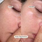 Vorher Nachher nach der Anwendung des Payalove Peeling bei Ölige Haut / Mischhaut